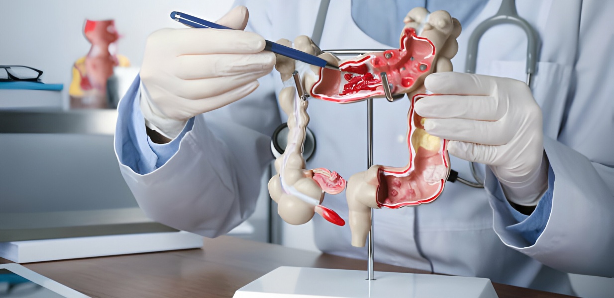 Todo paciente com Doença de Crohn vai ter câncer?
